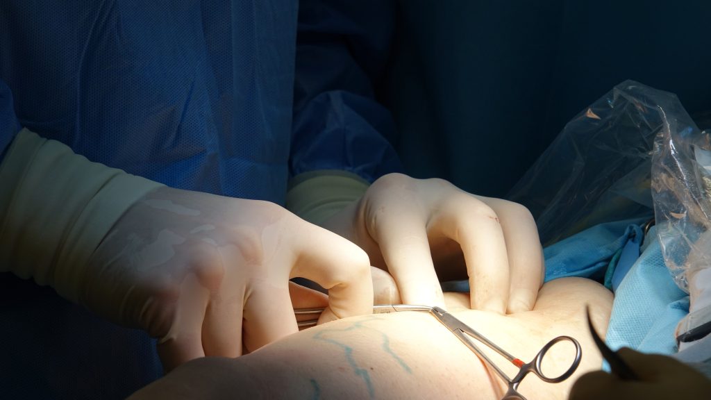 Hyménotomie dentaire : quels risques réels pour le nerf ?