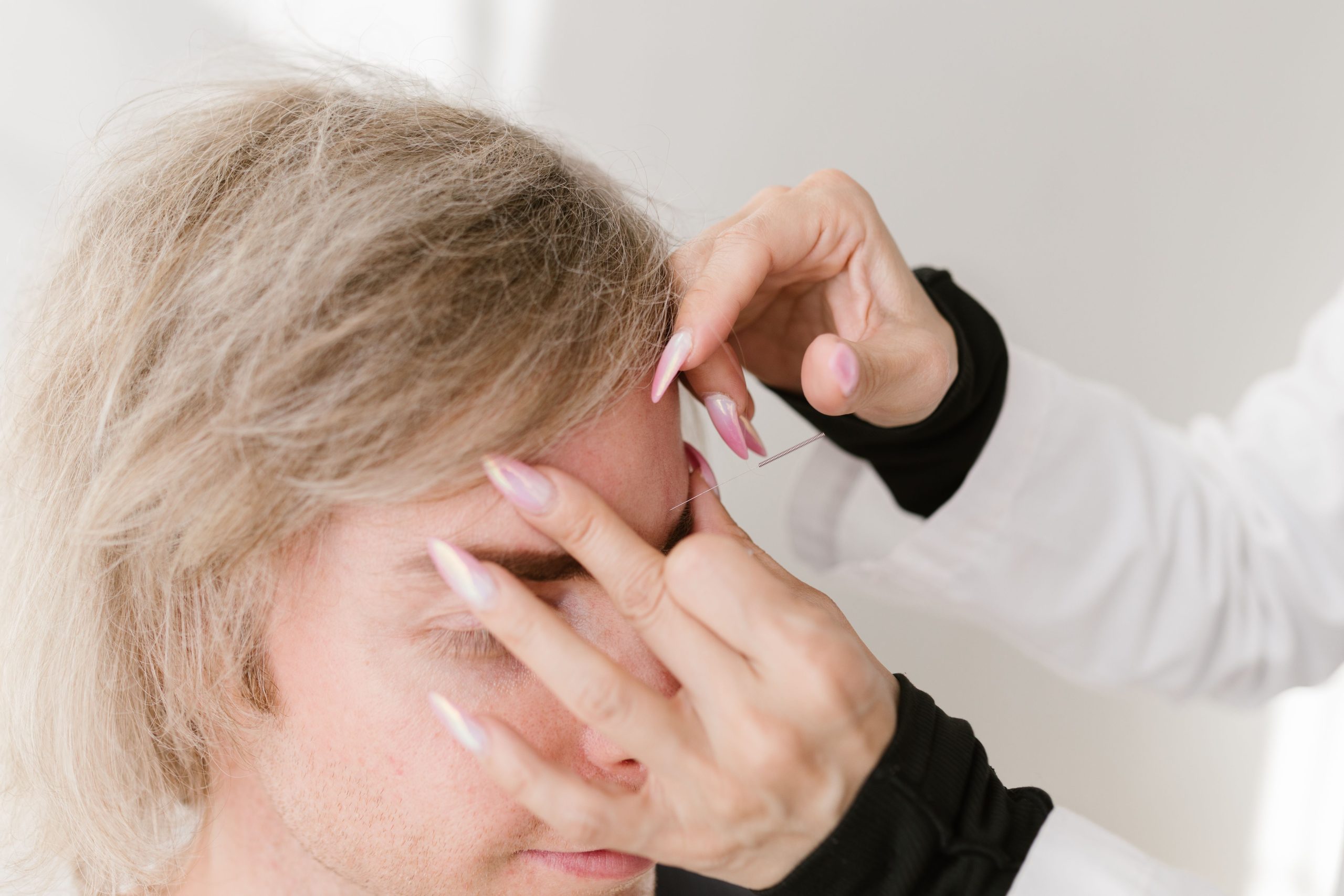 Acupuncture gros plan therapie holistique soulagement