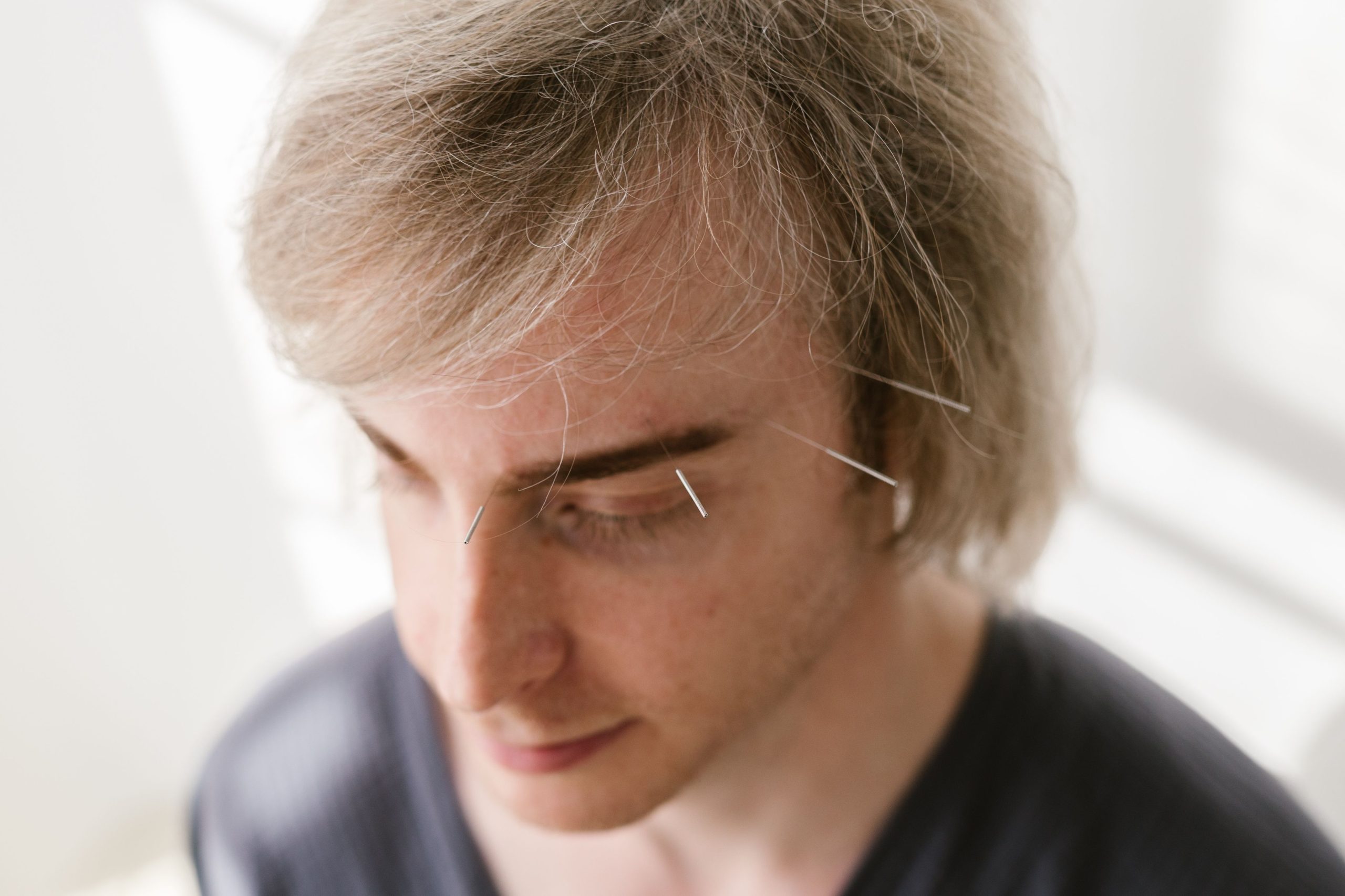 Acupuncture visage pour bien-être holistique