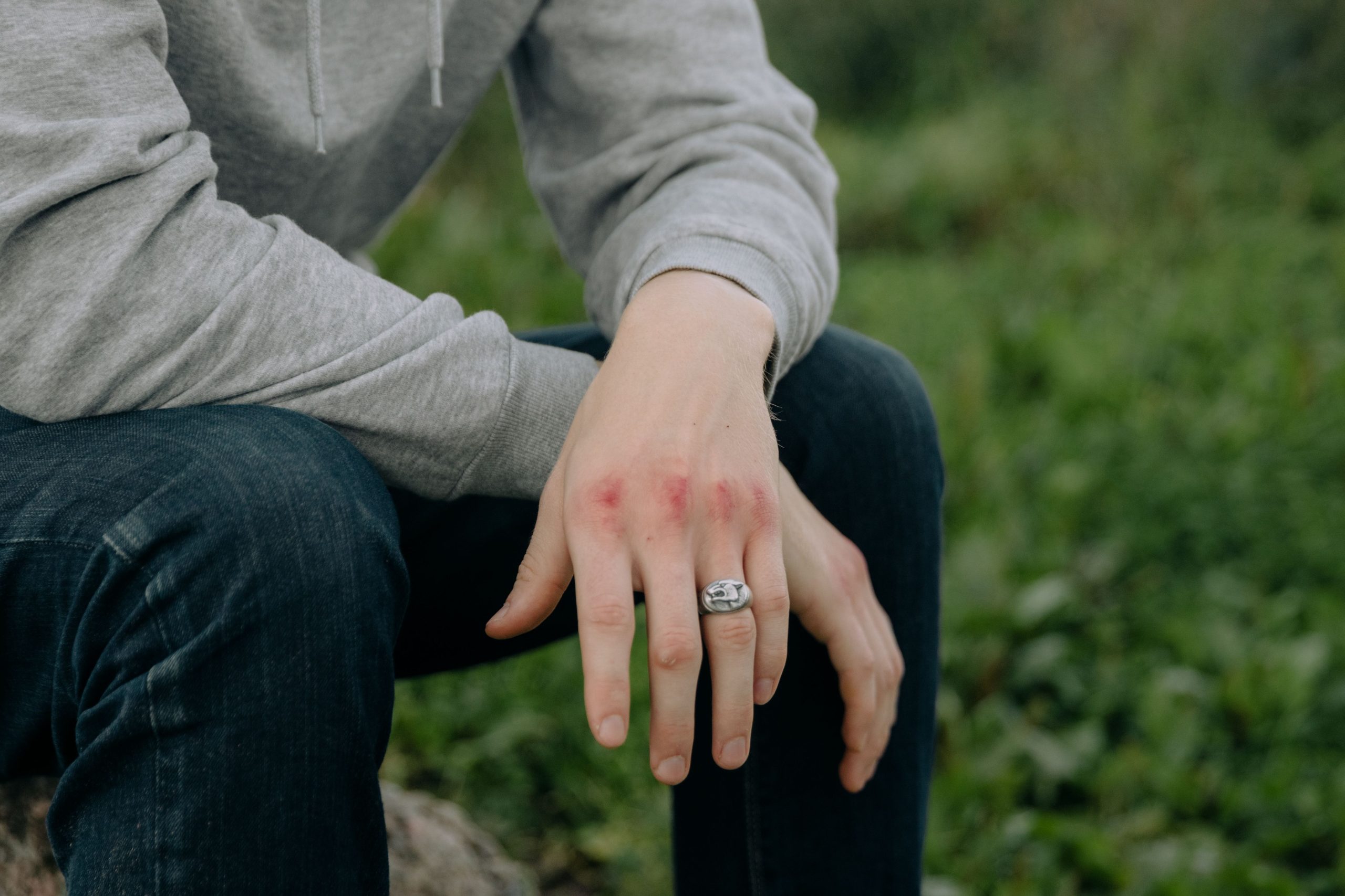 Mains contusionnees avec bague en exterieur