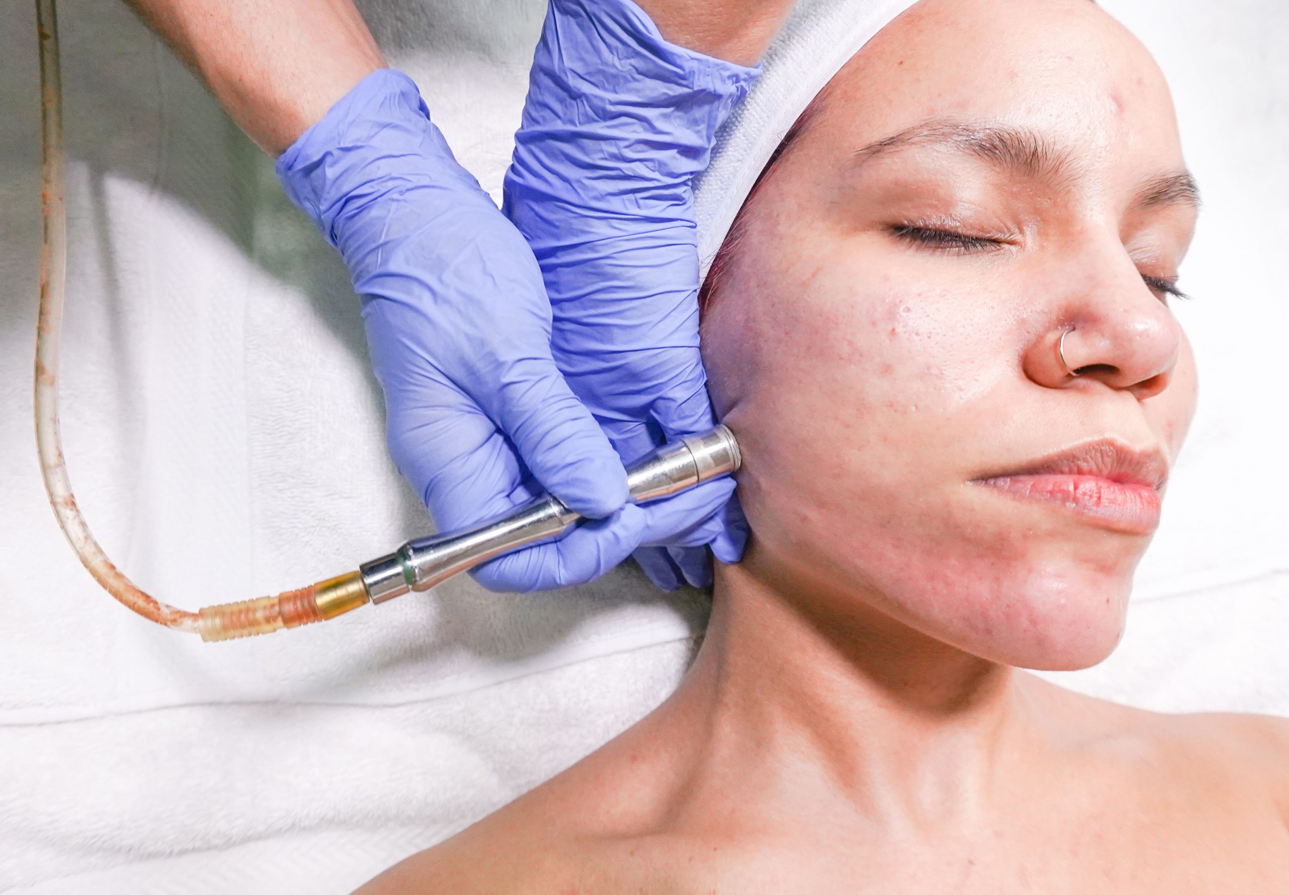 Traitement microdermabrasion professionnel du visage